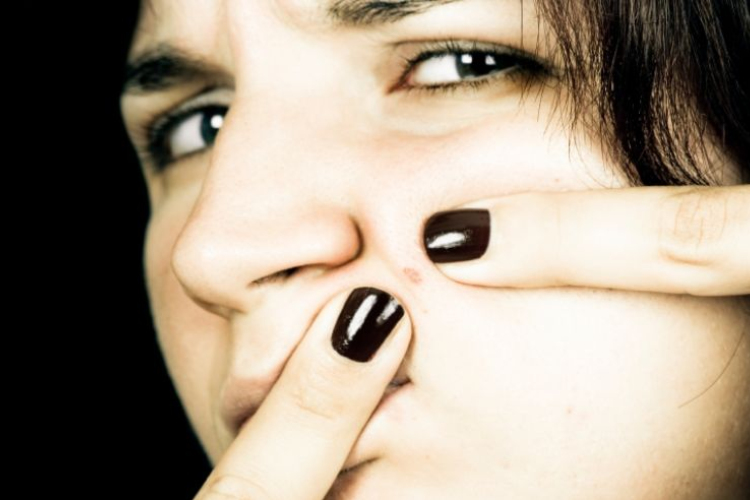 Tévhitek a pattanásokról