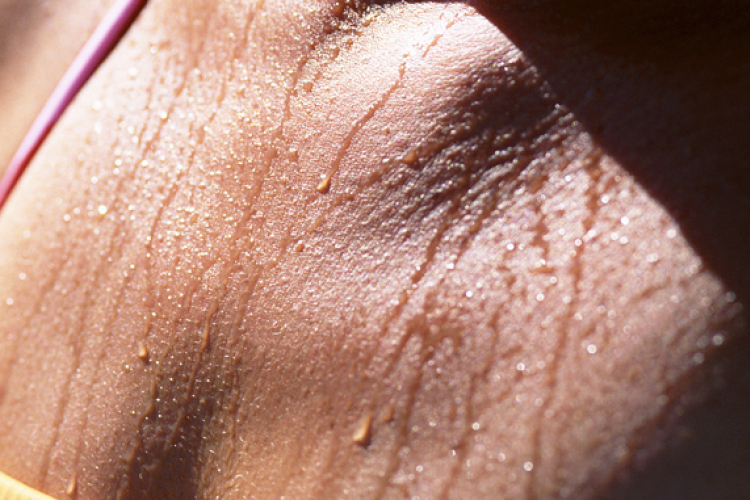 Hogyan kezelhető a túlzott izzadás? 